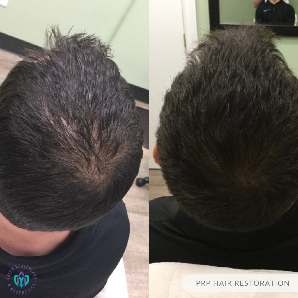 prp hair restoration