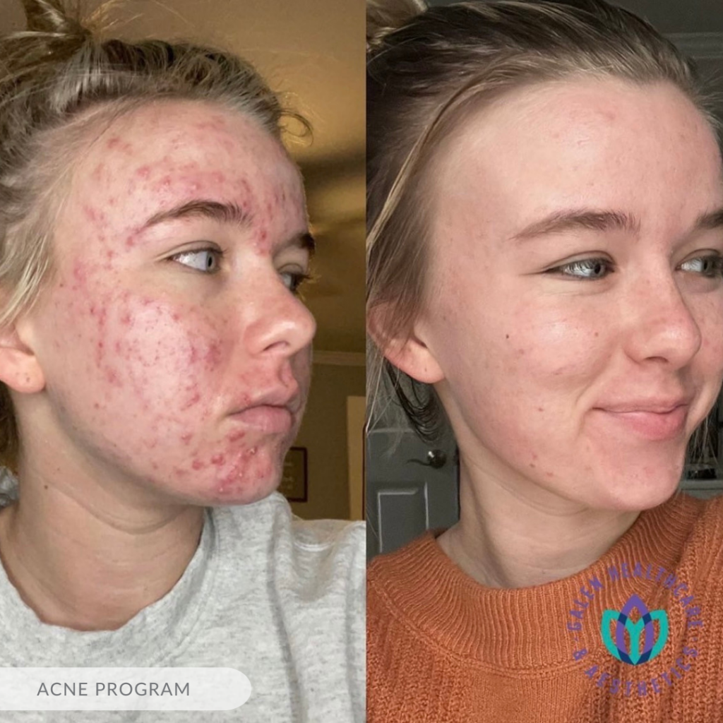 acne program